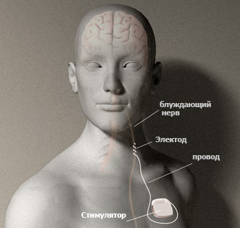 Стимуляция блуждающего нерва