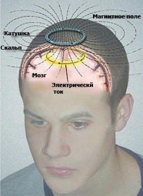 Транскраниальная магнитная стимуляция